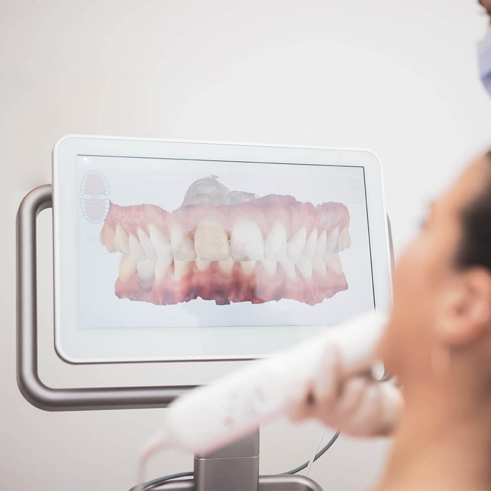 iTero mouth scanner